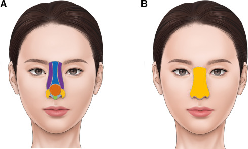 Aesthetic Nasal Reconstruction