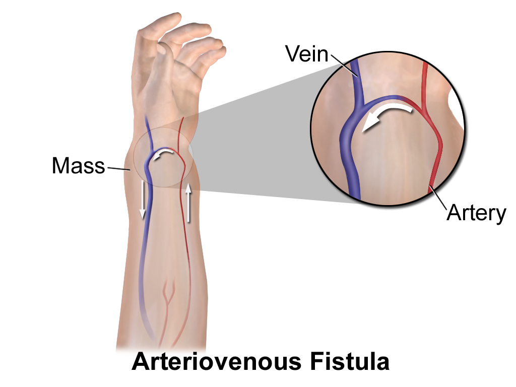 Arteriovenous Fistulas