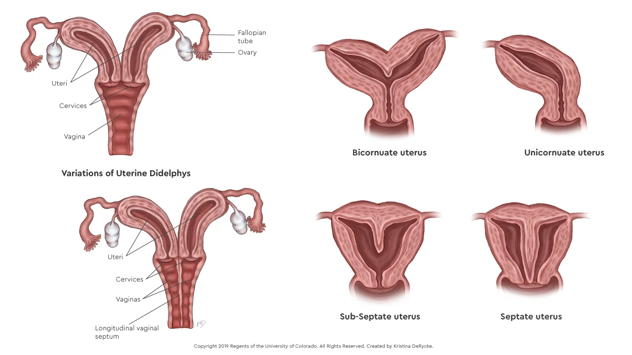 Congenital uterus development anamoly (Mullerian Anamoly)