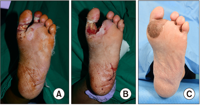 Diabetic Foot Salvage And Reconstruction