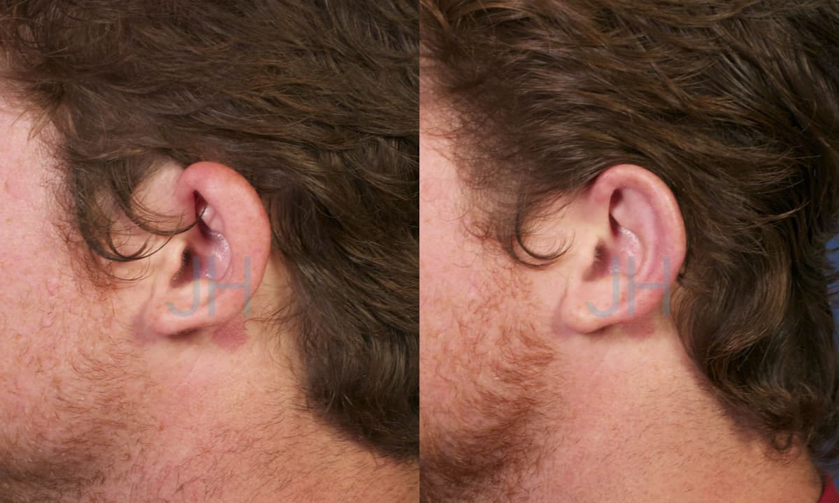 Ear Contour Correction