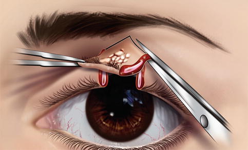 Eye Lid Reconstruction