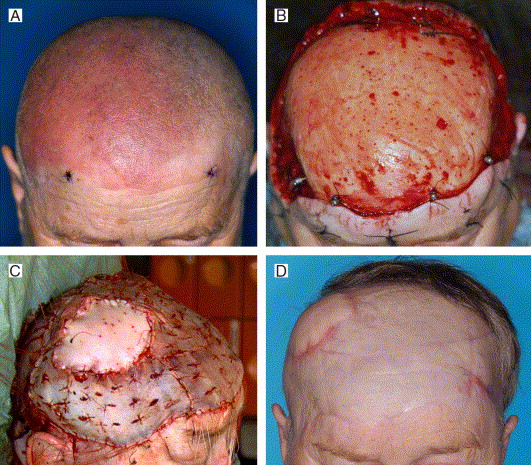 Forehead And Scalp Reconstruction