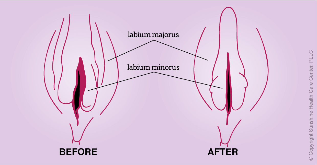 PRP Rejuvenation of Vagina