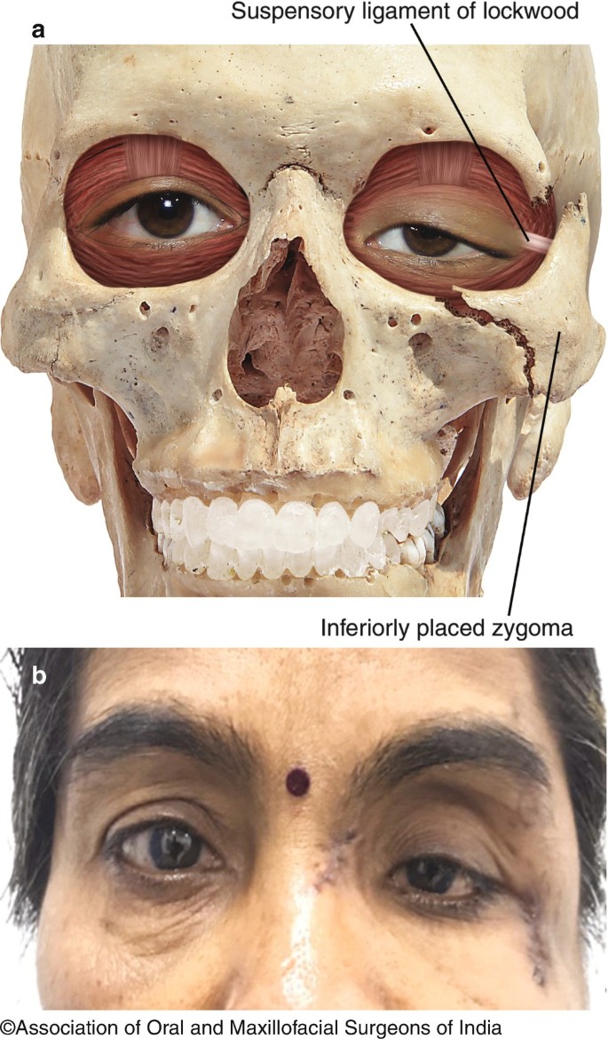 Zygomatic Fractures